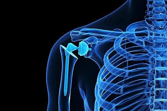 Intensive Musculoskeletal Parameter Tracking